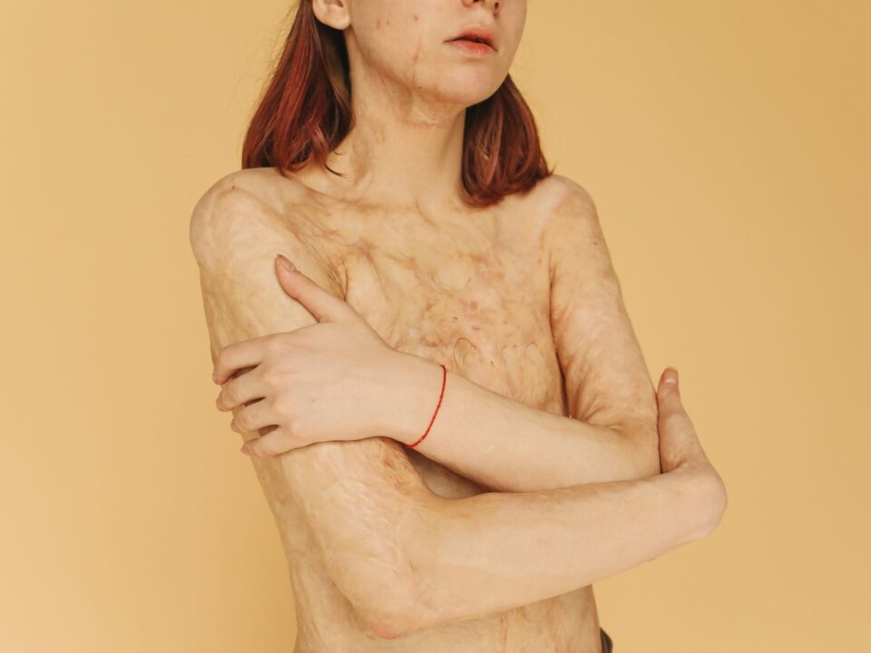Cilt Barajı (Skin Barrier) Bozulması Nasıl Anlaşılır ve Nasıl Onarılır?